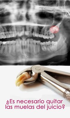 Ekstrakcija zuba - Oralna hirurgija
